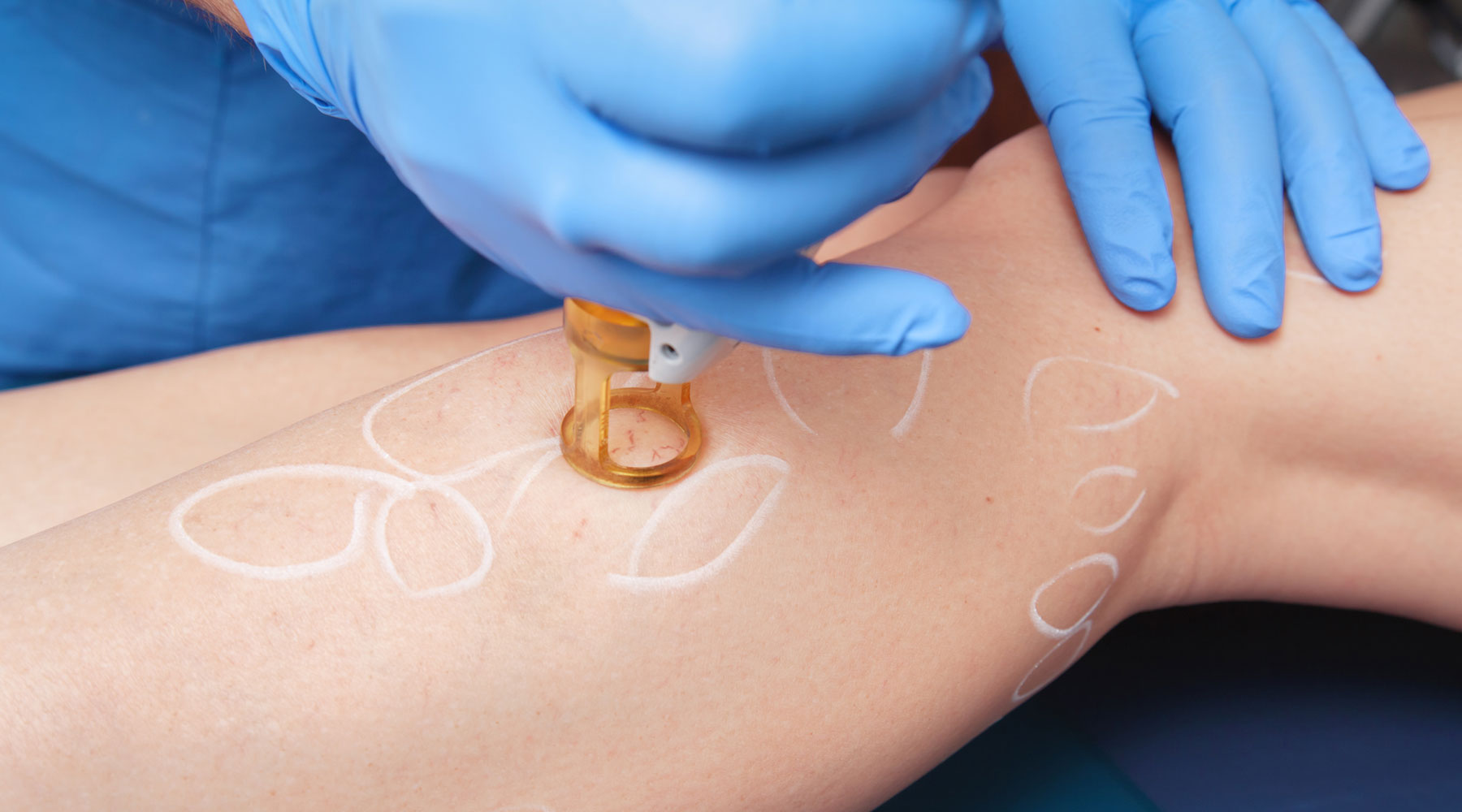 Dermatologische Lasertherapie — Hautärzte am Fastnachtsbrunnen